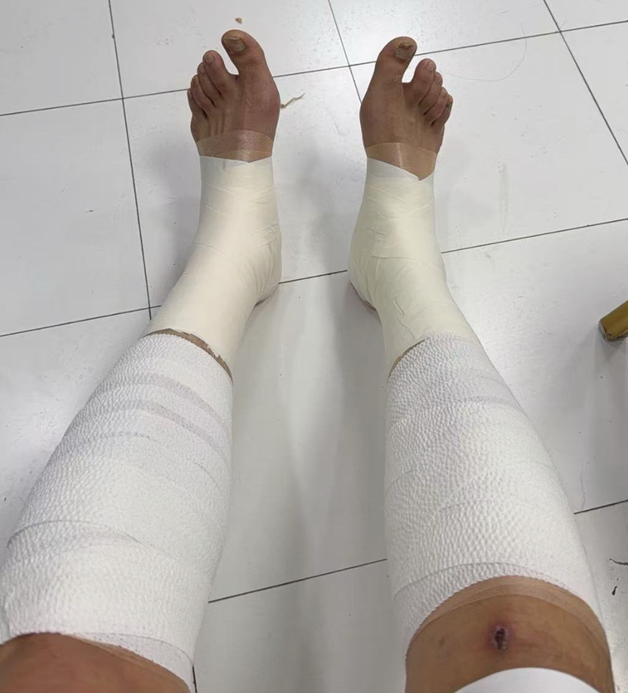 国际足联-胜山西谁注意翟晓川赛后伤势？双腿拉伤绑满绷带，看着都残忍！